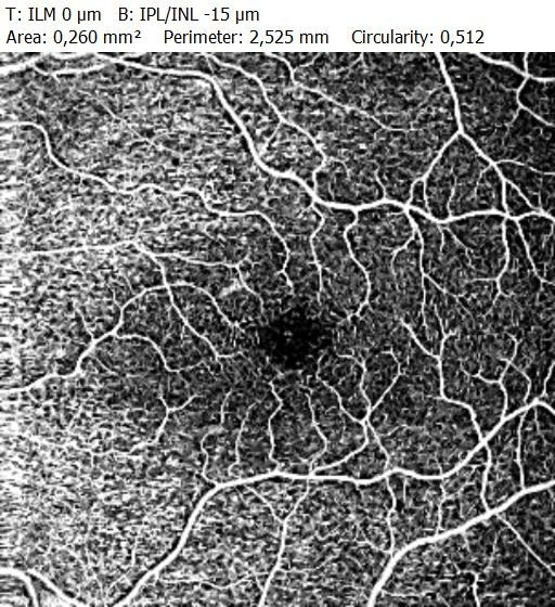OCT-Angiografie der Netzhautgefäße (Beispielbild)